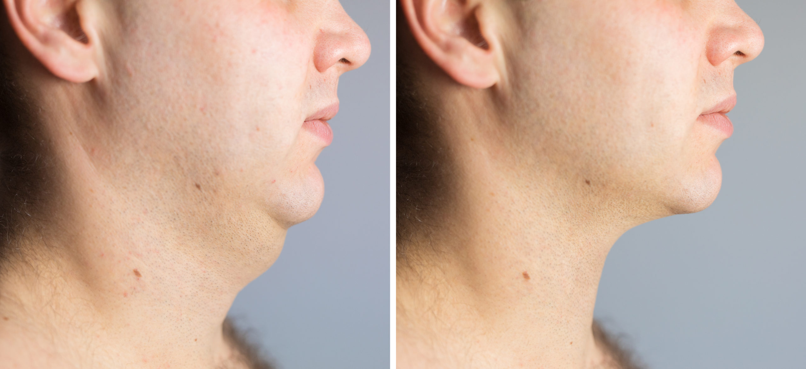 Man,Before,And,After,Double,Chin,Fat,Correction,Procedure